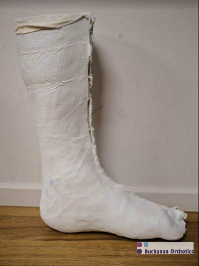 Plaster cast for an AFO